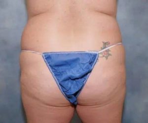 before back view butt lift female patient case 1758