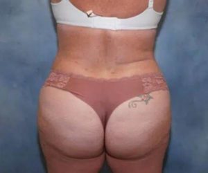 after back view butt lift female patient case 1758