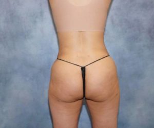 after front view butt lift female patient case 1774