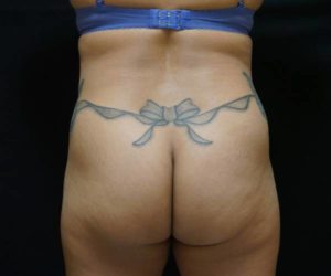 before back view butt lift female patient case 1787