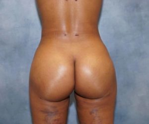 after back view butt lift female patient case 1802