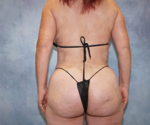 after butt lift female patient back view case 3296