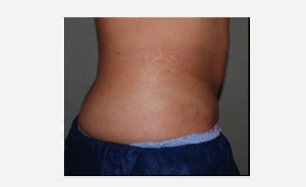 After CoolSculpting Female Patient Side Angle View Case 1102