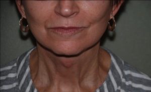 After Facelift Female Patient Front Angle View Case 1250