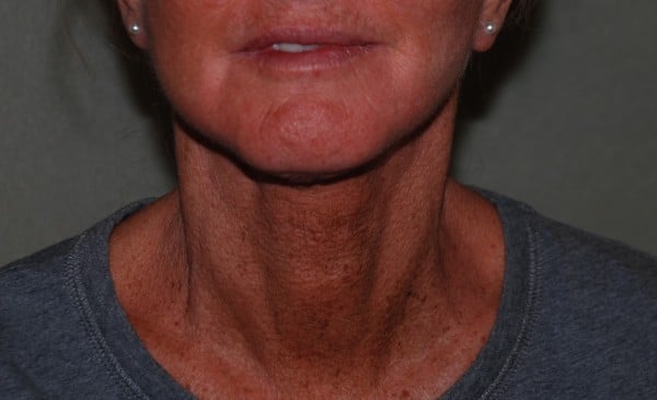 After Facelift Female Patient Front Angle View Case 1250