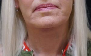 After Facelift Female Patient Front Angle View Case 1269