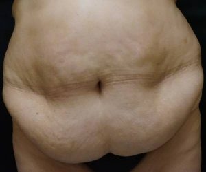 Before Lipo Abdominoplasty Female Patient Front Angle View Case 1221