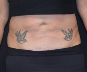 After Liposuction Female Patient Front Angle View Case 1204