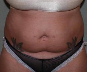 Before Liposuction Female Patient Front Angle View Case 1204