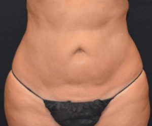 After Liposuction Female Patient Front Angle View Case 1208