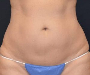 Before Liposuction Female Patient Front Angle View Case 1208