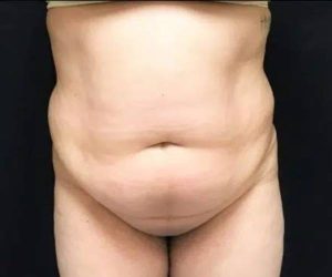 Before Liposuction Female Patient Front Angle View Case 1709