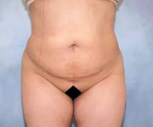 After Liposuction Female Patient Front Angle View Case 1709