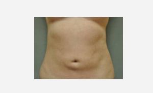 after front view liposuction female patient case 1868