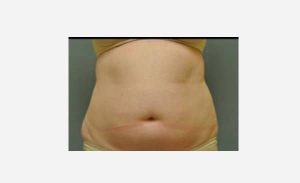 before front view liposuction female patient case 1868