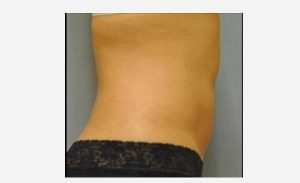 after right view breast augmentation female patient case 1871