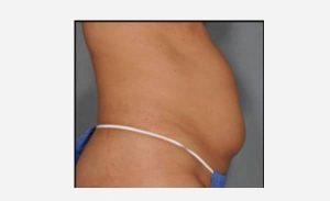 before right view breast augmentation female patient case 1871