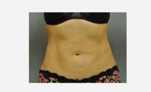 after front view liposuction female patient case 1895