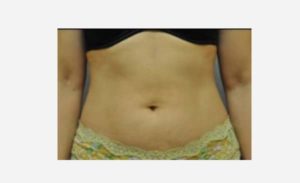 before front view liposuction female patient case 1895