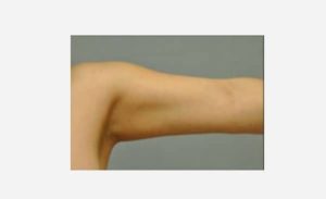 after front view liposuction female patient case 1901