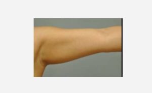 before front view liposuction female patient case 1901