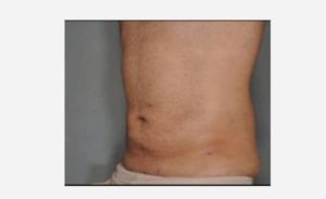 after left view liposuction male patient case 1914