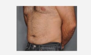 before left view liposuction male patient case 1914