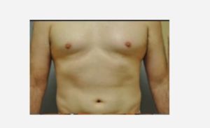after front view liposuction male patient case 1920