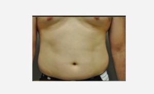before front view liposuction male patient case 1920