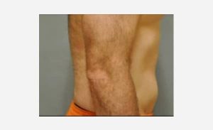 after right view liposuction male patient case 1925