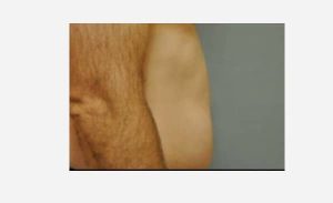 before right view liposuction male patient case 1925