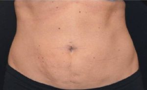 after front view liposuction female patient case 1930