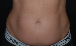 before front view liposuction female patient case 1930