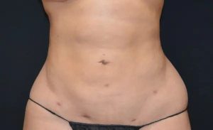 after front view liposuction female patient case 1946