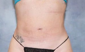 after front view liposuction female patient case 1986