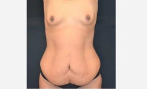 Before Mommy Makeover Female Patient Front Angle View Case 1538