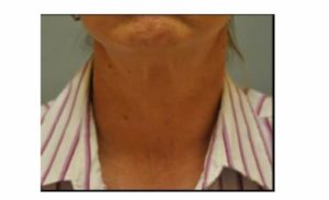 after neck lift front view female patient case 2374