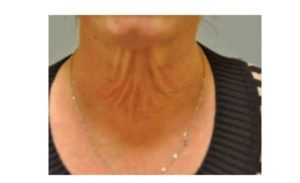 before neck lift front view female patient case 2374