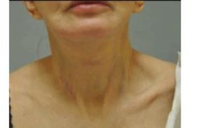 after neck lift front view female patient case 2378