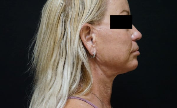 after neck lift right side view female patient case 2388