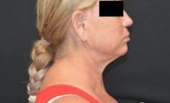 before neck lift right side view female patient case 2388