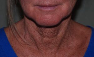 before neck lift front view female patient case 2676