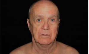 before neck lift front view male patient case 2679