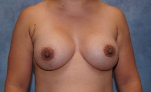 after breast augmentation front view case 6152
