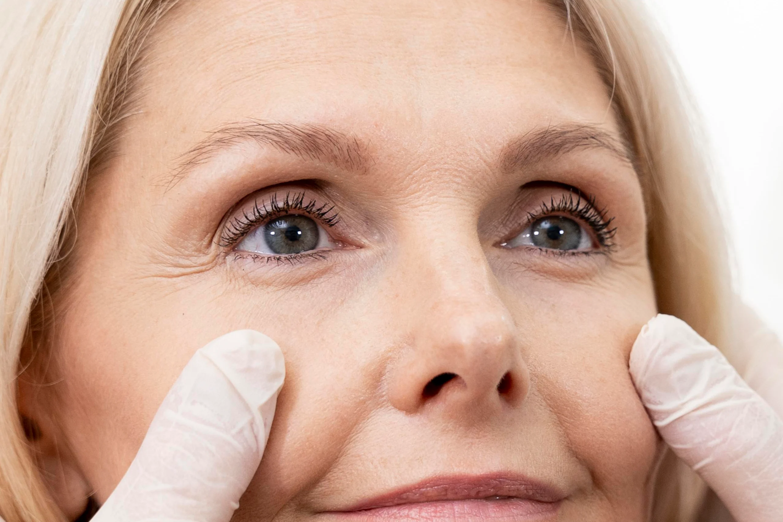 Looking for Non-Surgical Eyelift? We can help!