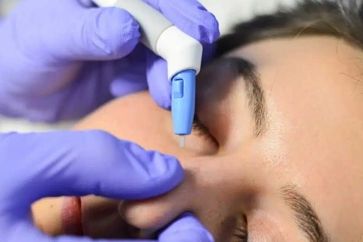 What’s Agnes RF Microneedling?