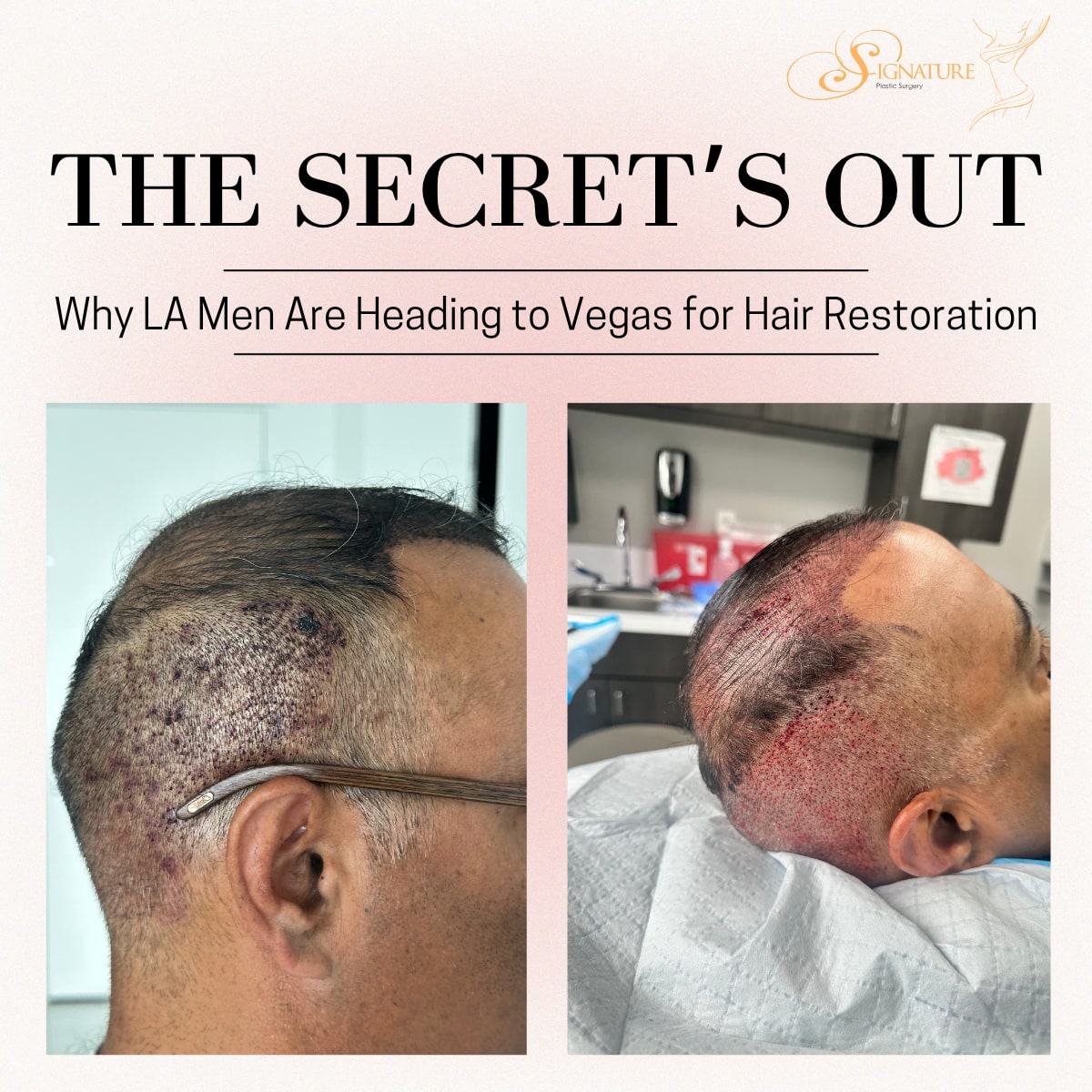Hair Restoration: Why More Los Angeles Men Are Traveling to Las Vegas for Better Results