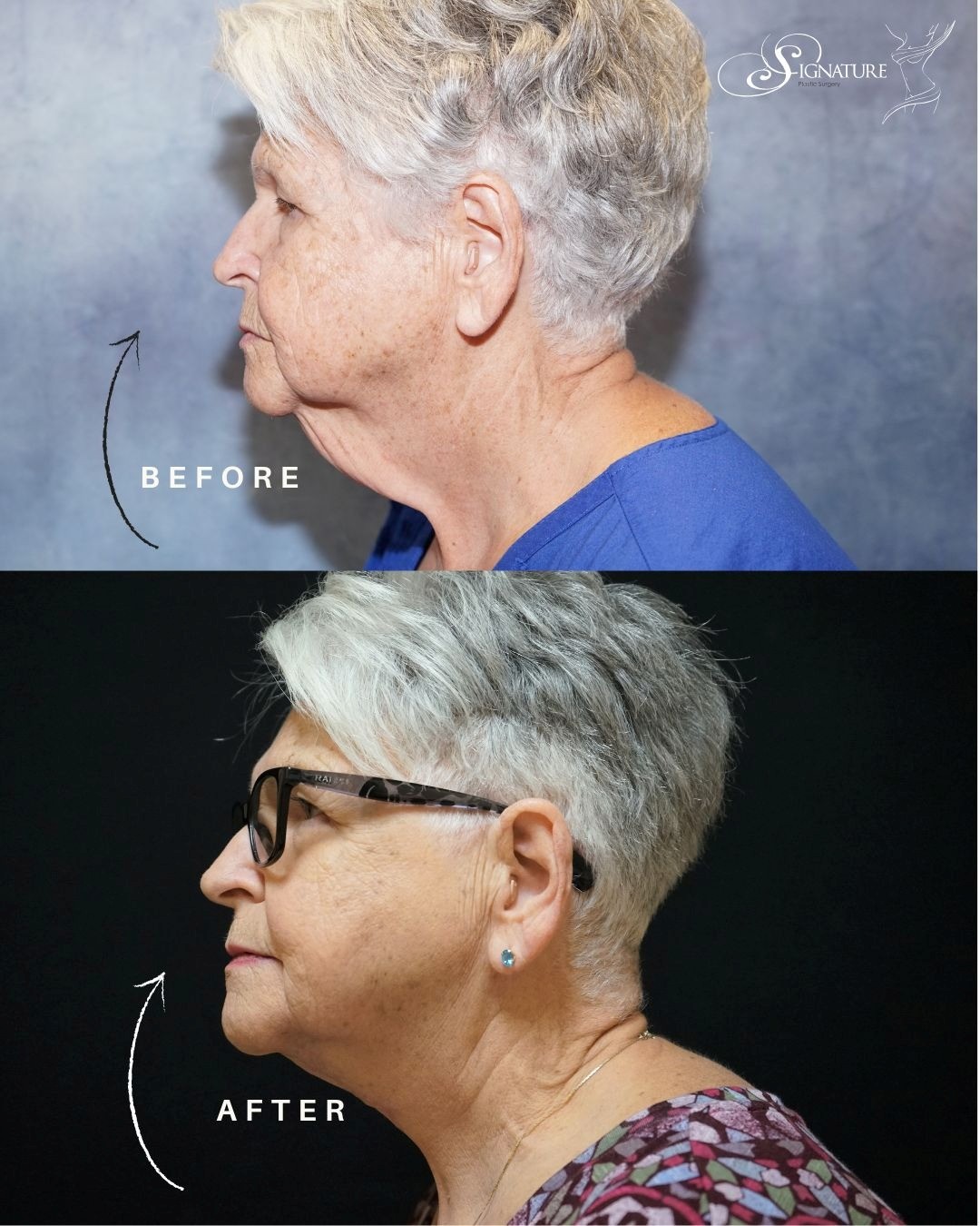 How a Neck Lift Restores a Youthful Jawline
