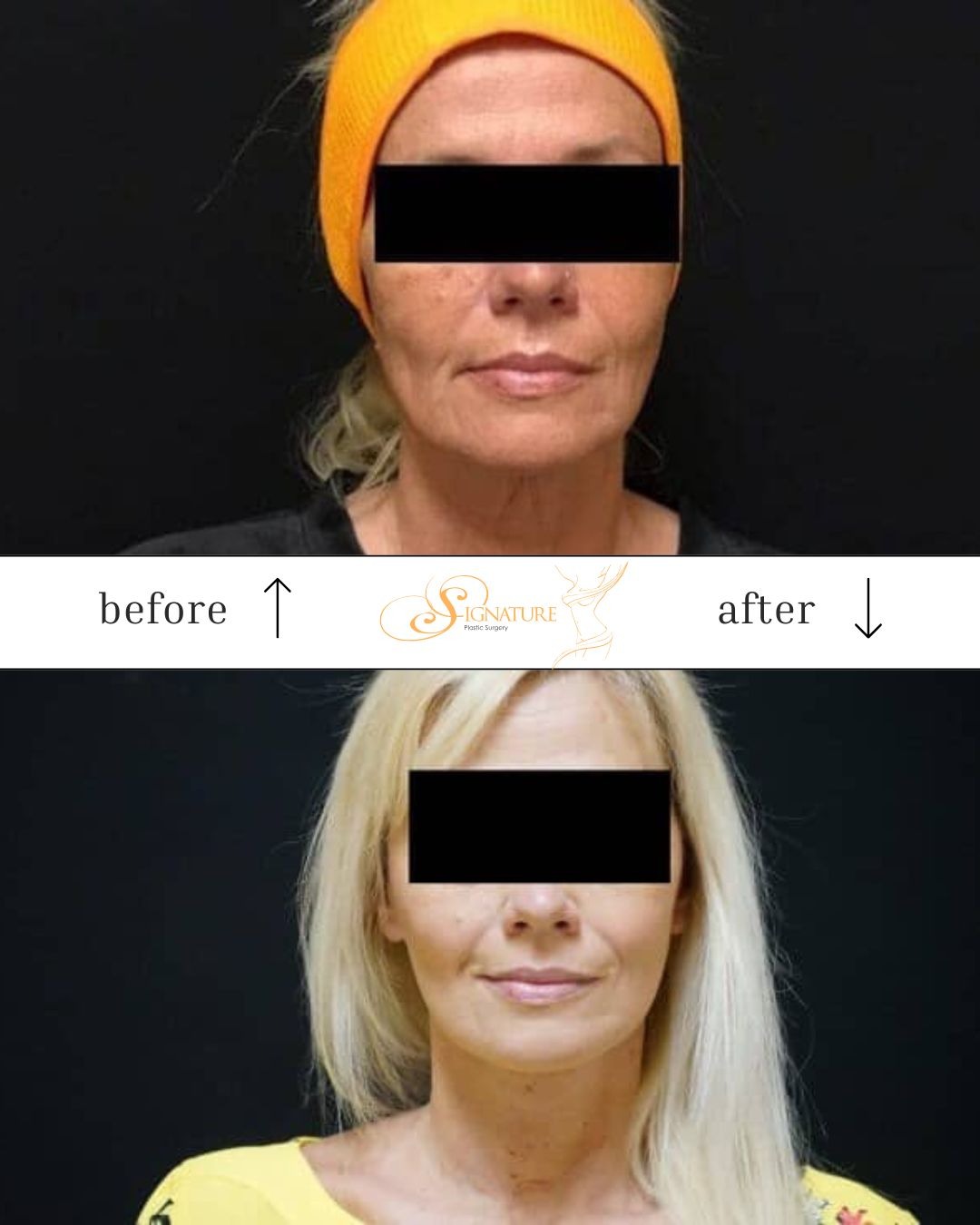 Common Facelift Myths That Keep Patients From Getting Natural Results