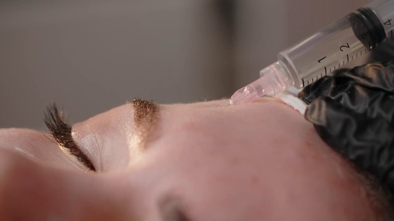 Botox: The Ultimate Guide